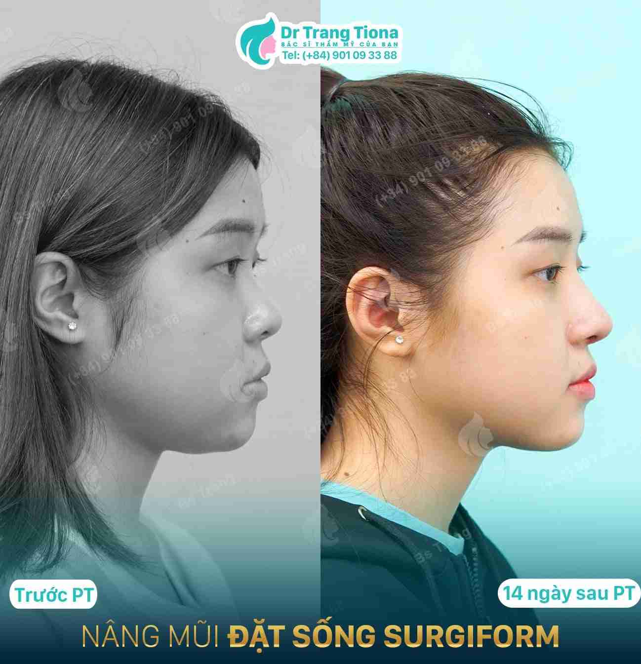 Tại sao lại bị mụn sau nâng mũi? Có nguy hiểm không?