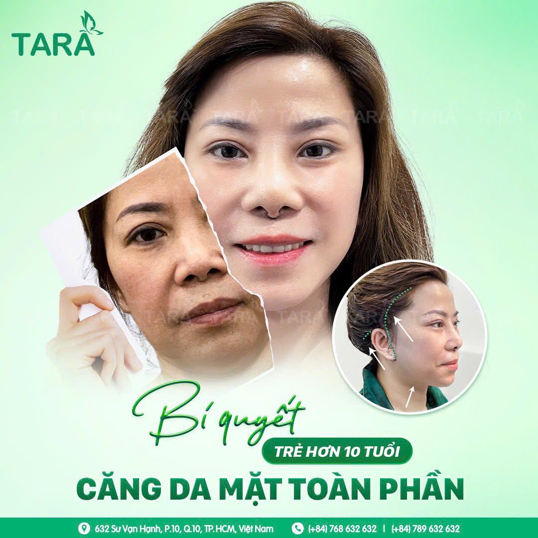 Căng Da Mặt 3SD Là Gì? Tại Sao Đây Là Bước Đột Phá Trong Trẻ Hóa Đa Tầng?