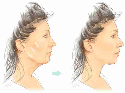 Căng da Midface bao lâu thì vết thương lành?