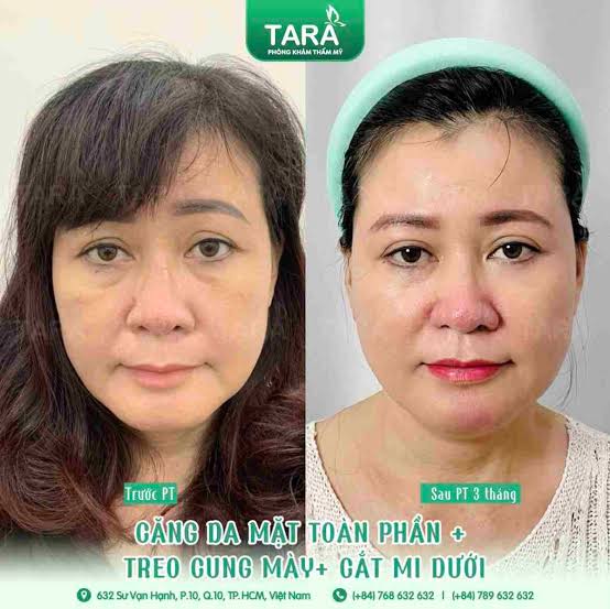 Căng Da Nâng Cơ Toàn Diện 3SD – Giải Pháp Trẻ Hóa Tầng Sâu Lưu Giữ Nét Thanh Xuân Dài Lâu