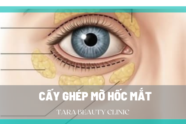 Cấy Mỡ Hốc Mắt Tự Thân