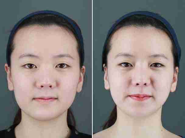 Cấy mỡ mặt Baby Face có hiệu quả lâu dài không?