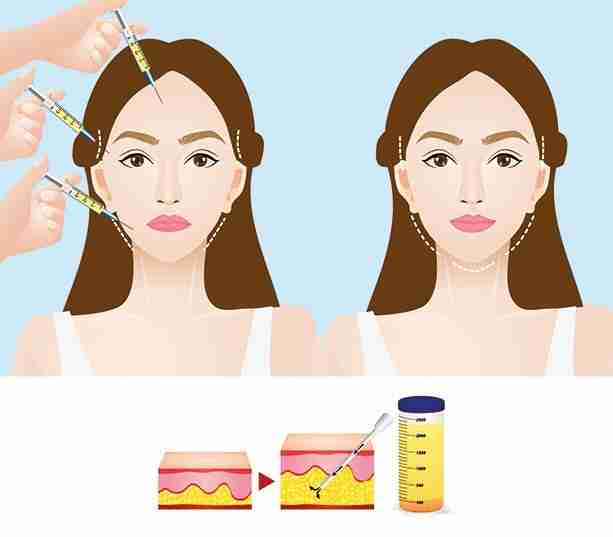 Cấy mỡ mặt giá bao nhiêu, cần lưu ý gì khi thực hiện?
