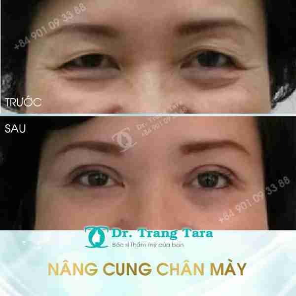 Tổng quan về nâng cung chân mày xóa tan sụp mí