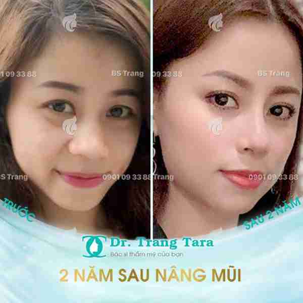 Khắc Phục Mũi Lệch Vẹo