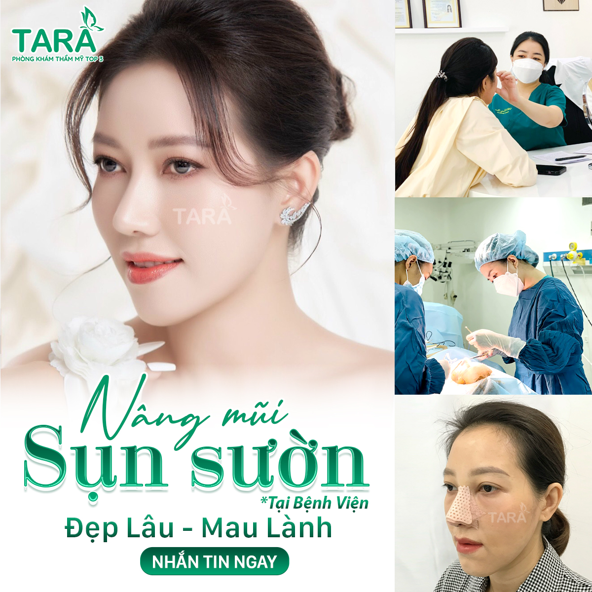 Nâng mũi cấu trúc