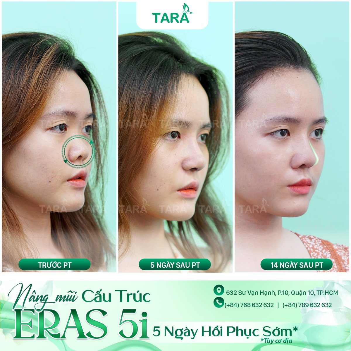 NÂNG MŨI ERAS 5i – 5 NGÀY PHỤC HỒI
