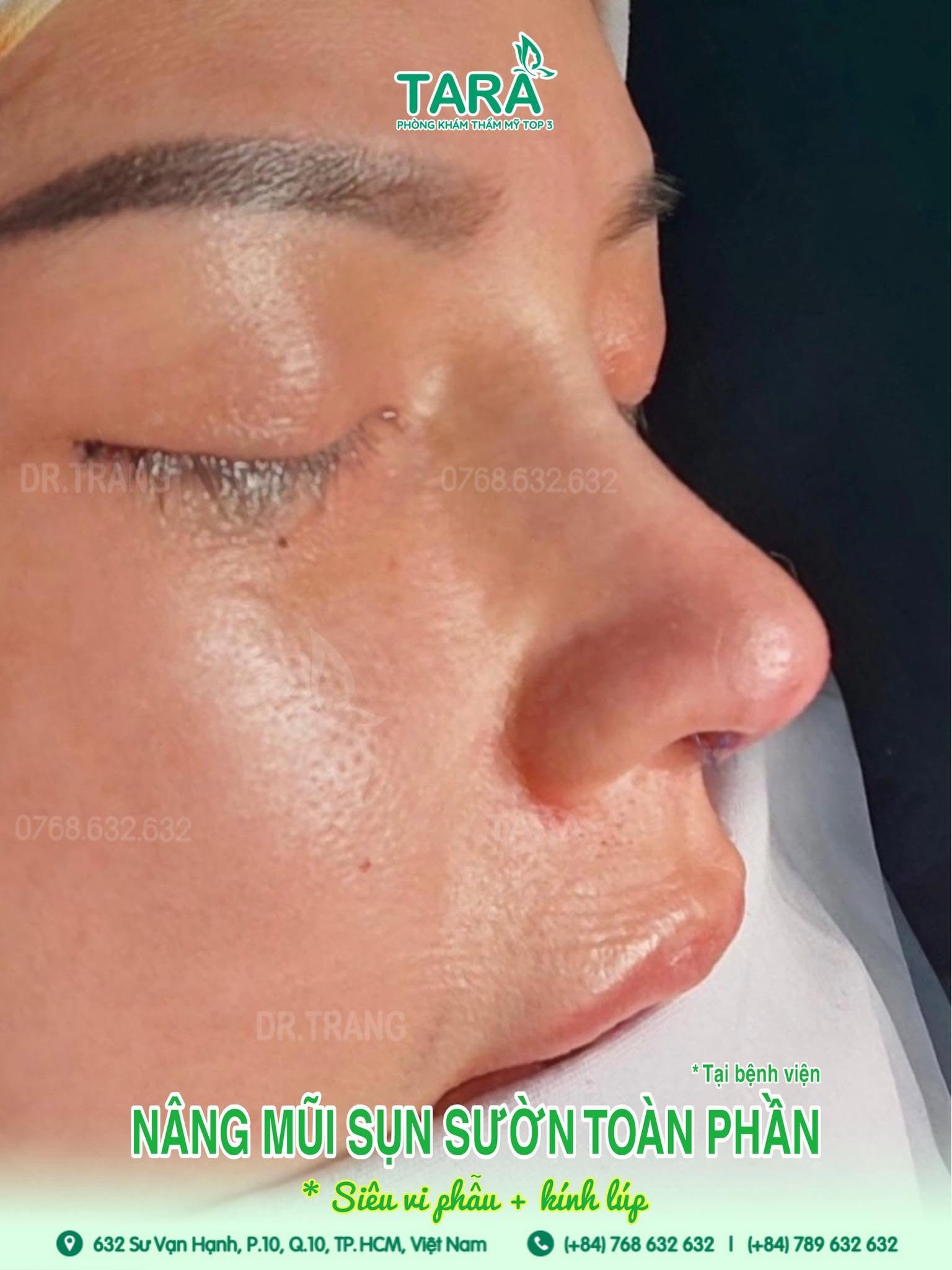 Nâng Mũi Không Nẹp Có Phải Kiêng Nhiều Không? Khi Nào Đi Làm, Makeup, Đeo Kính Lại Được?
