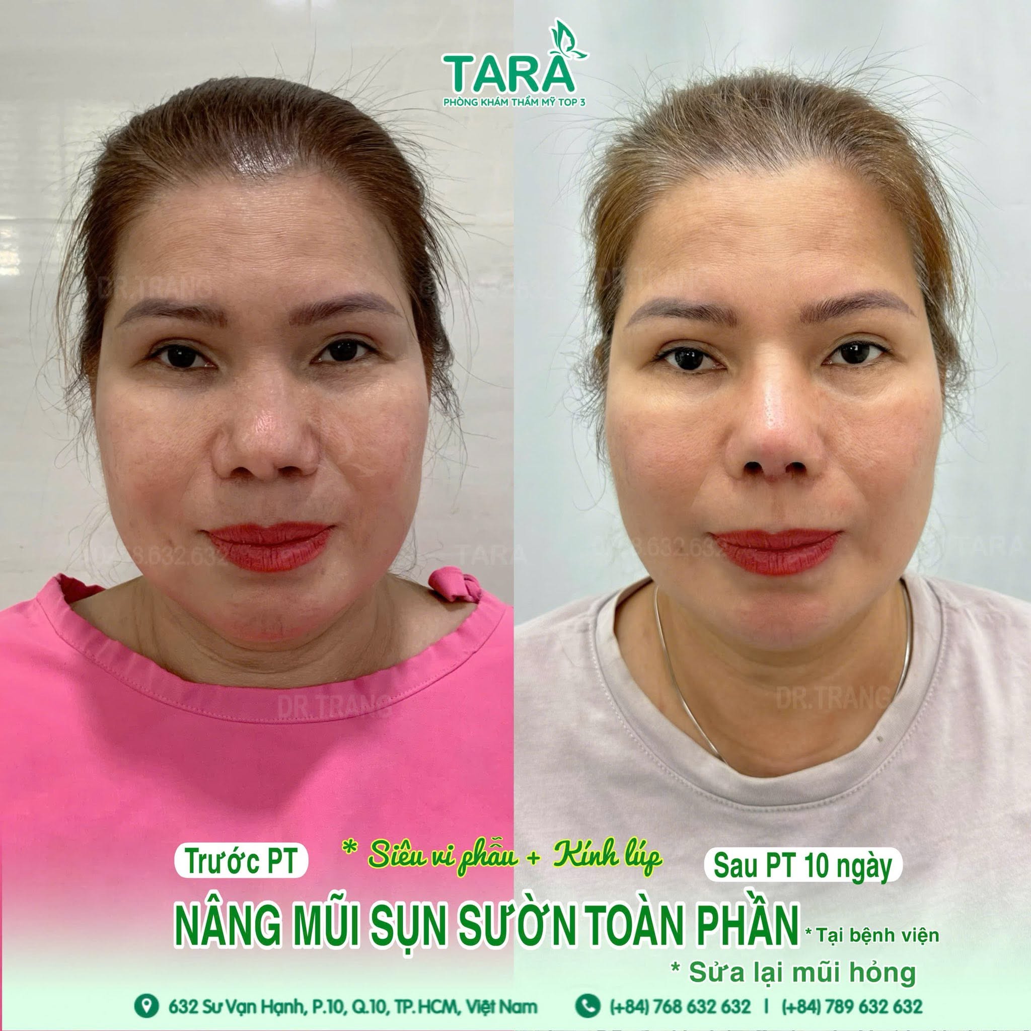 Nâng Mũi Không Nẹp Nhanh Lành "Cá Nhân Hóa" - Giải Pháp Thẩm Mỹ Độc Bản, Không Chạy Theo Hot Trend