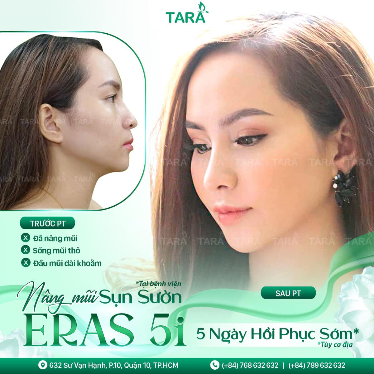 Nâng mũi sụn sườn