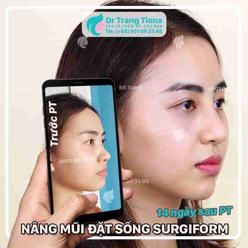 Nâng mũi sống Surgiform là gì? Nâng mũi sống Surgiform có tốt không?