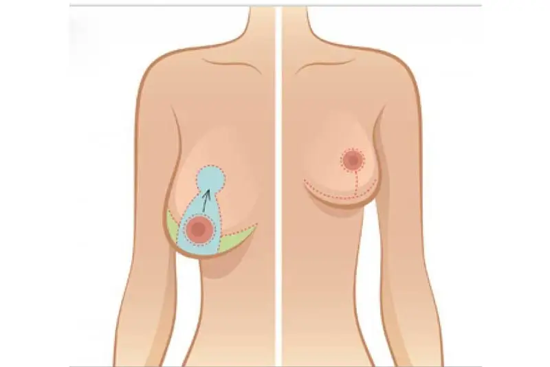 Nâng vòng 1 nhỏ sau sinh khác gì nâng ngực bình thường? Lưu ý riêng cho mẹ bỉm