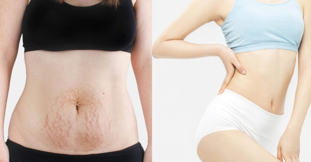 Sau sinh bao lâu thì có thể làm Mommy makeover? Mẹ còn cho con bú có làm được không?