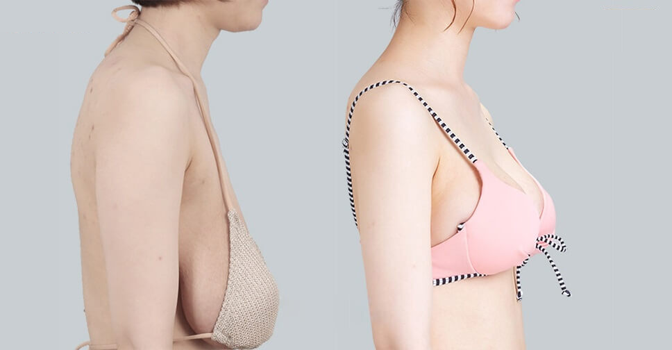 Treo ngực sa trễ là gì – Giải đáp từ bác sĩ phẫu thuật