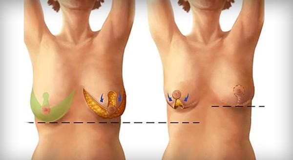 Treo Sa Trễ Nâng Mô Ngực Kết Hợp Treo Nội Tuyến – Giải Pháp Phòng Ngừa Tái Phát Bền Vững