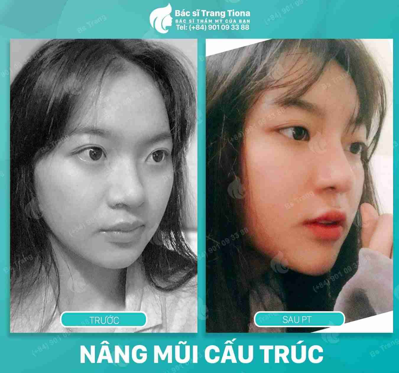 2 cách gội đầu sau khi nâng mũi để không ảnh hưởng vết mổ