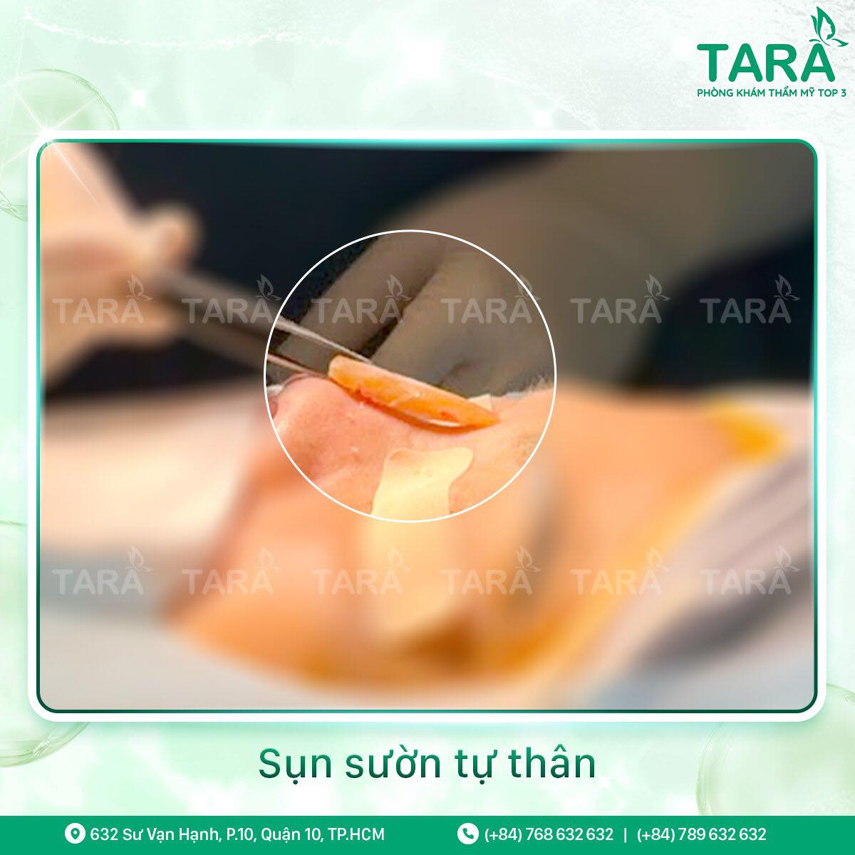 3 lầm tưởng nghiêm trọng về nâng mũi sụn sườn