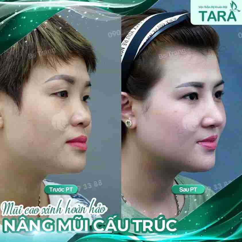 3 lưu ý quan trọng khi nâng mũi sau 10 ngày