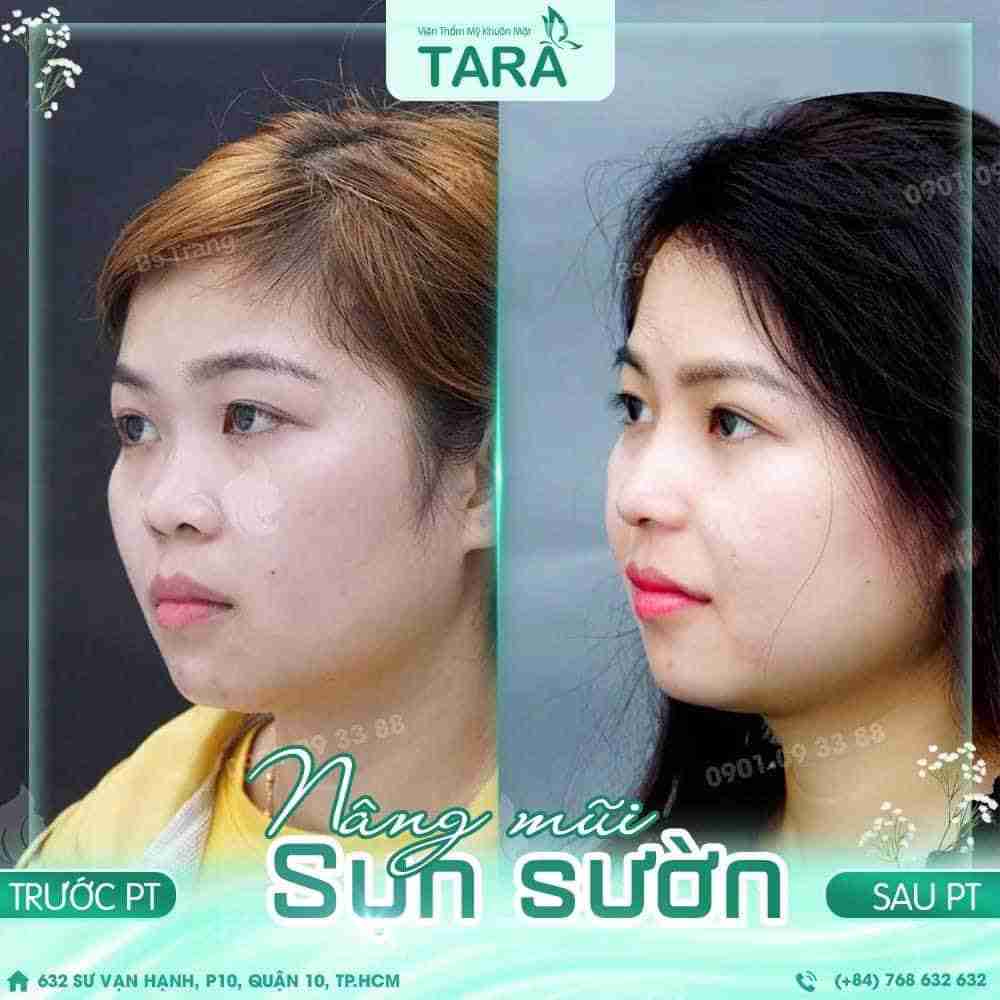 3 lưu ý quan trọng khi nâng mũi sau 10 ngày