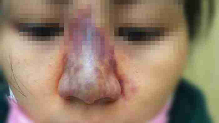 4 biến chứng khi tiêm filler mũi và cách phòng tránh