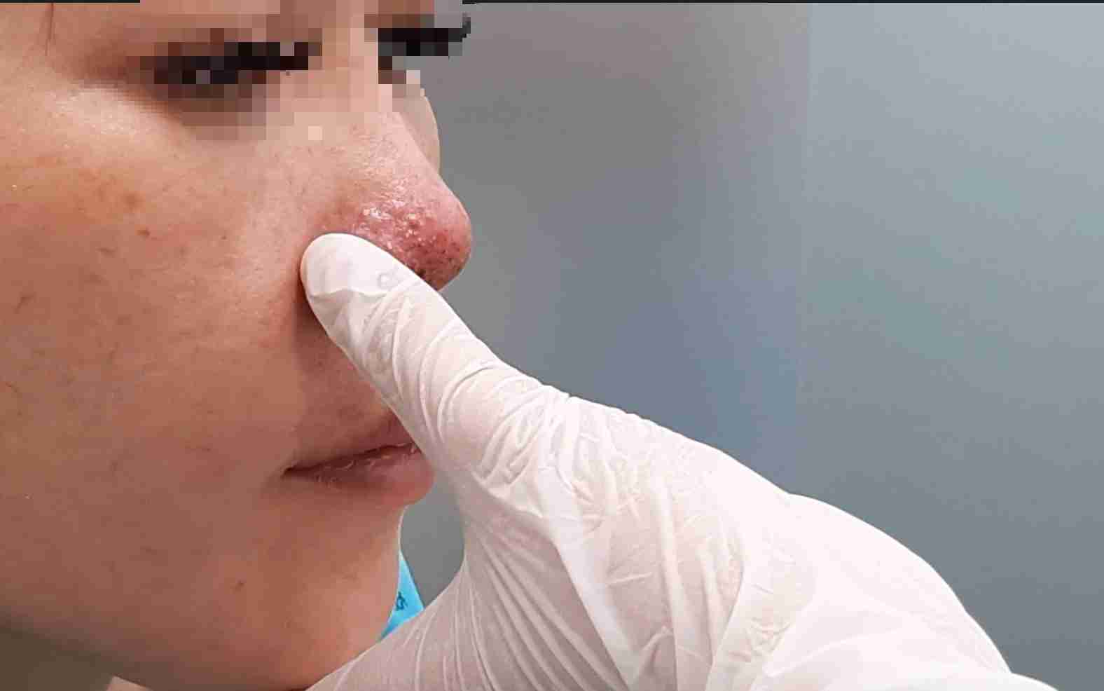 4 biến chứng khi tiêm filler mũi và cách phòng tránh