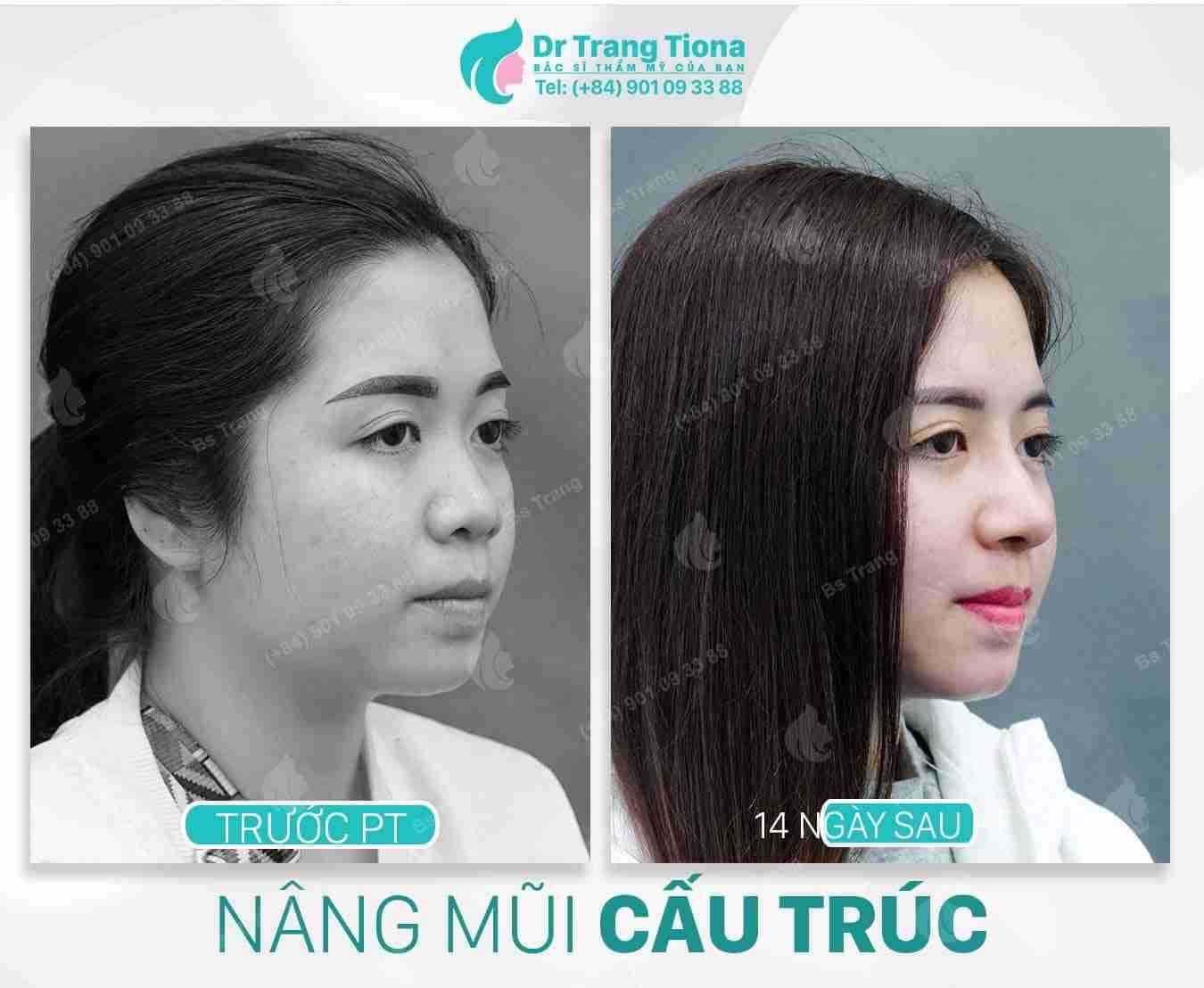 4 dấu hiệu nhận biết dị ứng sụn sau nâng mũi?