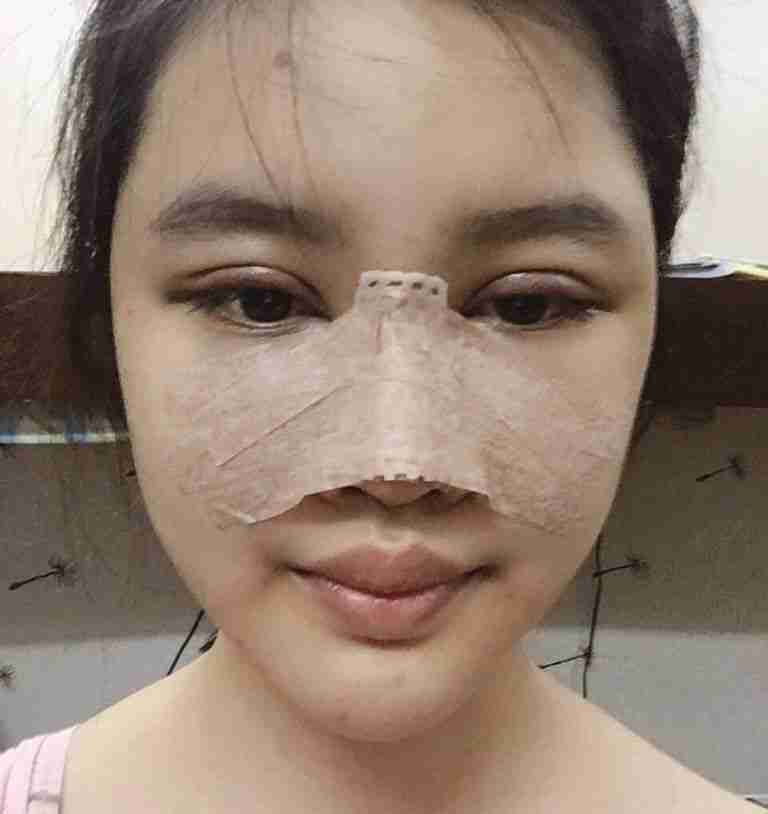 4 dấu hiệu nhận biết mũi bị biến chứng sau nâng mũi