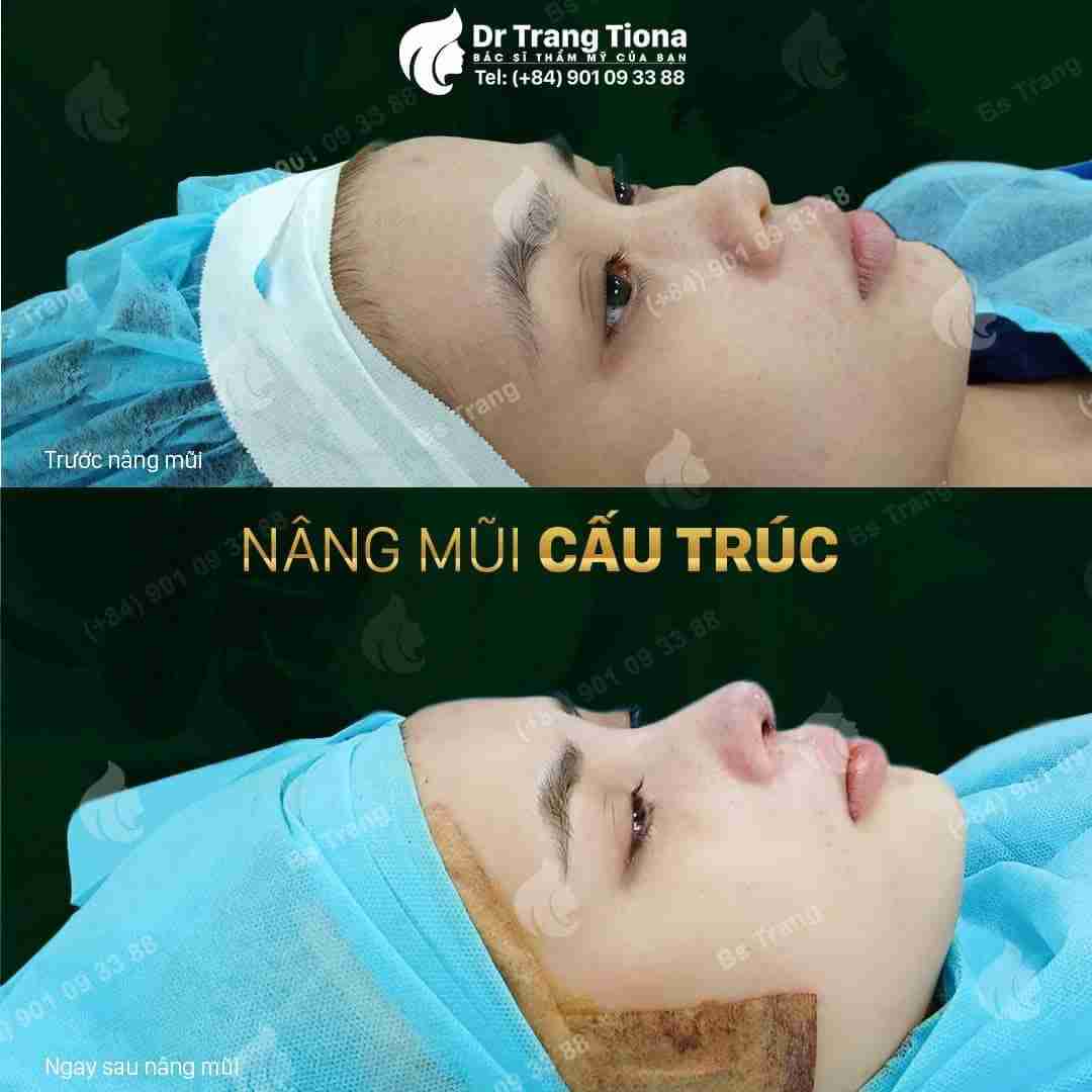 4 dấu hiệu nhận biết mũi bị biến chứng sau nâng mũi