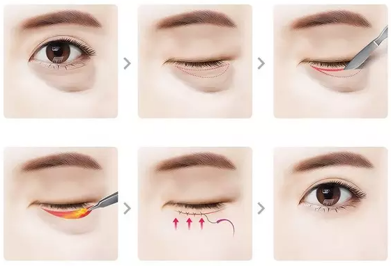 4 điều cần biết trước khi lấy bọng mỡ mắt