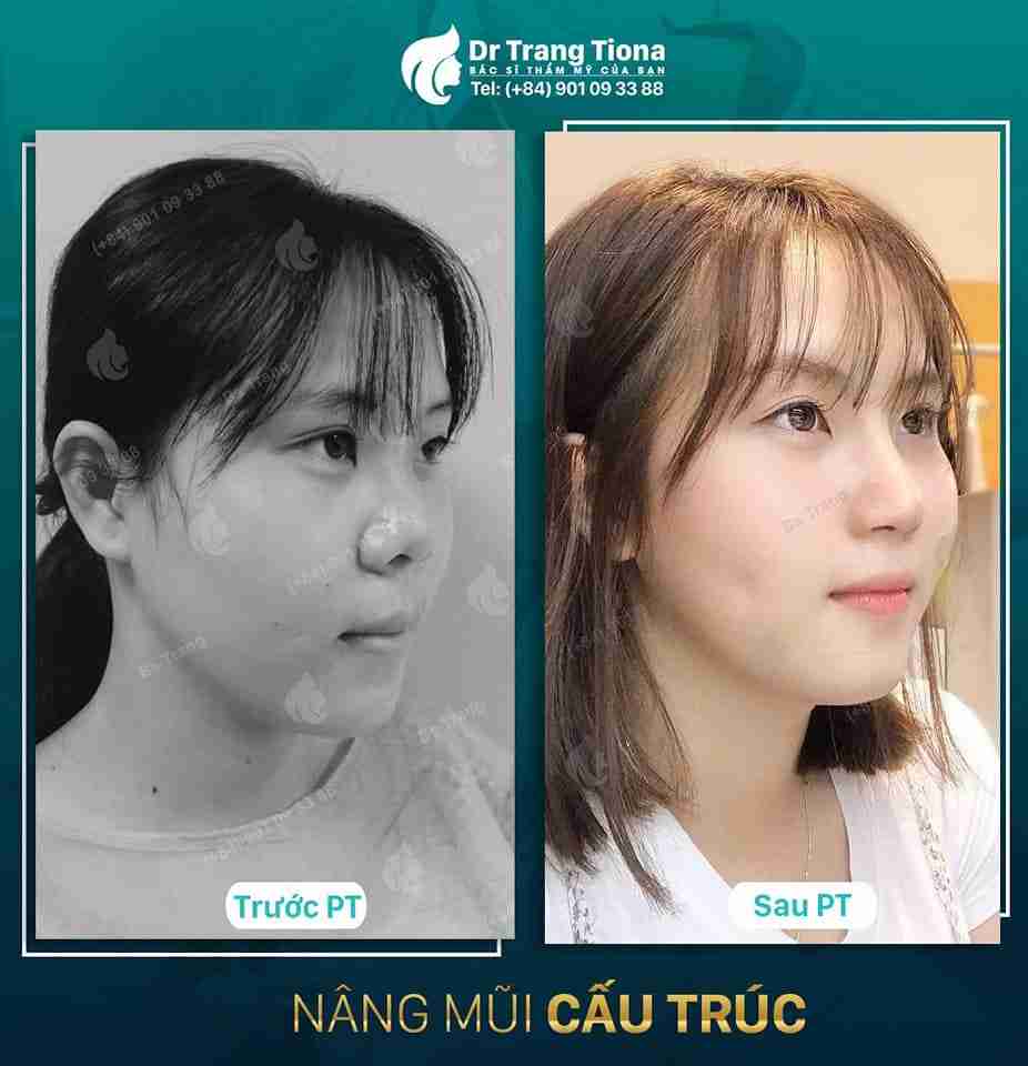 4 kinh nghiệm chăm sóc sau nâng mũi bạn cần biết