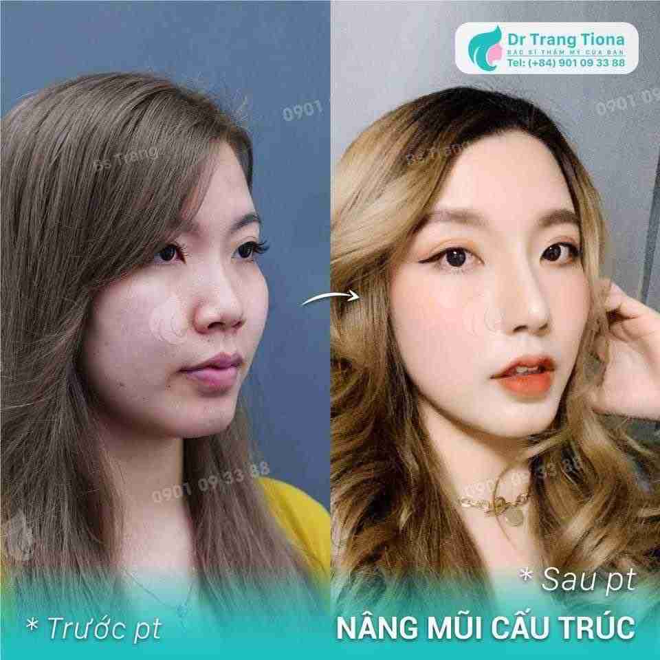 5 cách giảm sưng sau nâng mũi giúp hồi phục nhanh