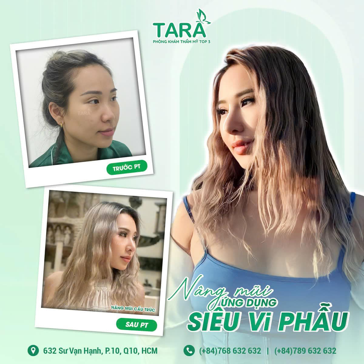 5 cái nhất về nâng mũi  ứng dụng siêu vi phẫu