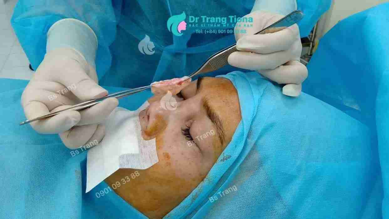 5 lưu ý khi sửa mũi bị hỏng để tránh “tiền mất tật mang”