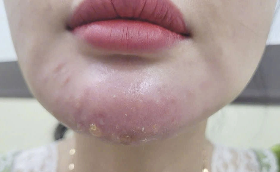 5 vị trí tiêm filler nguy hiểm cần đặc biệt lưu ý