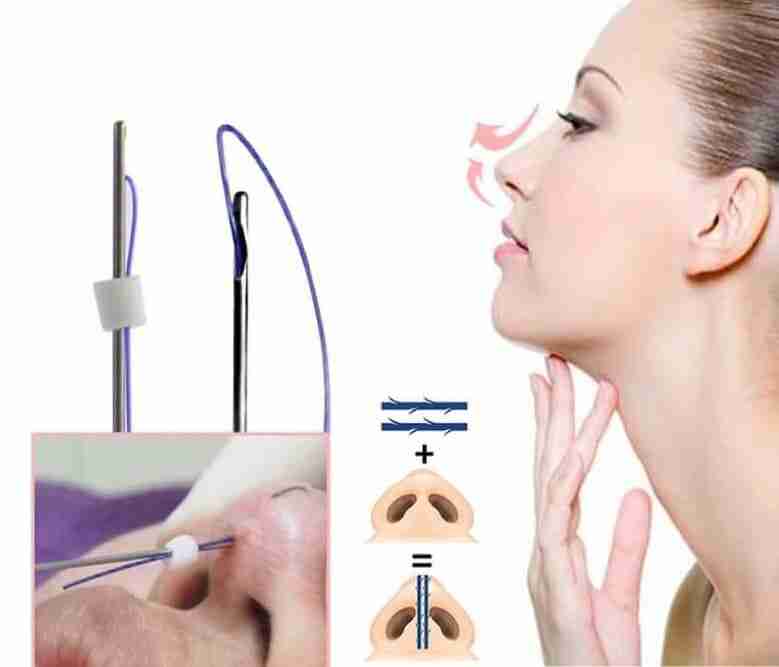 7 lưu ý khi nâng mũi bằng chỉ mà bạn cần biết