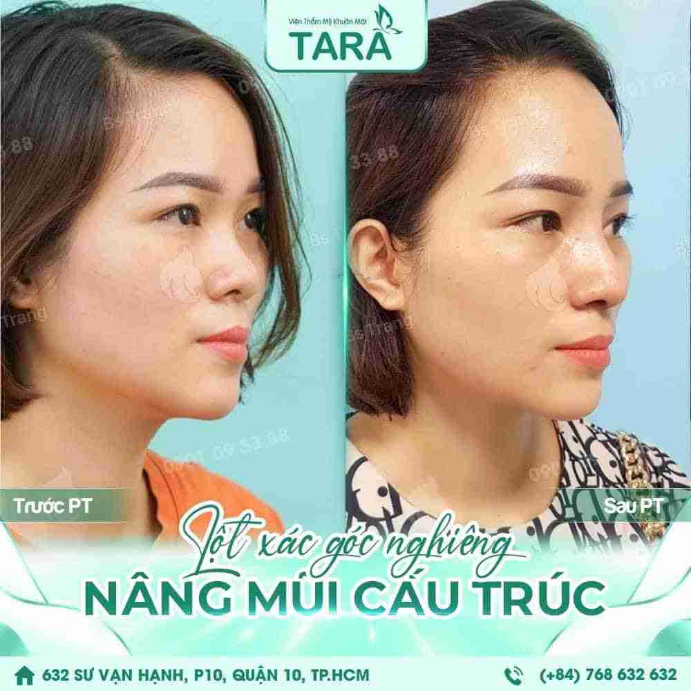 7 lưu ý quan trọng trước khi nâng mũi mà bạn cần phải biết
