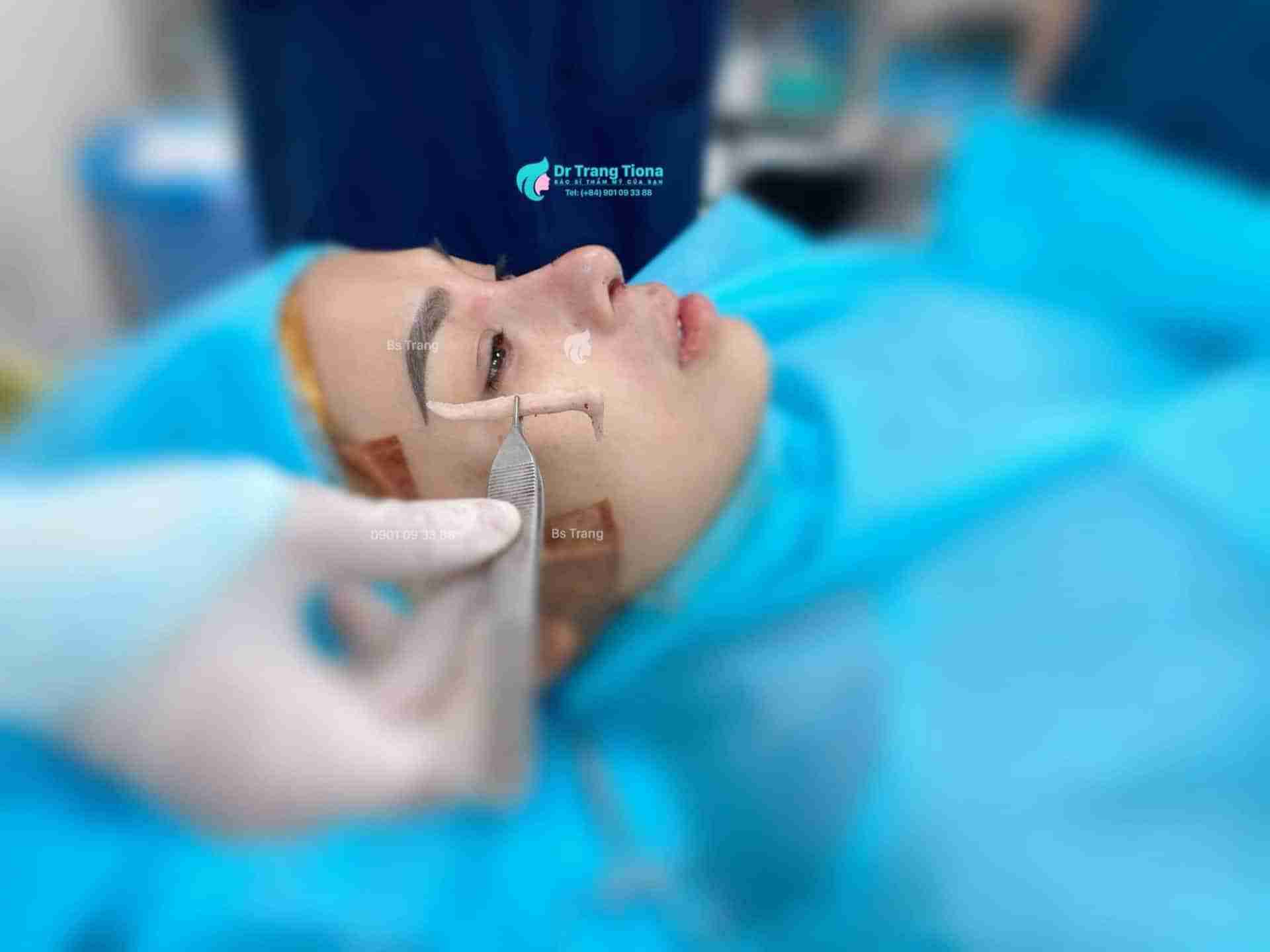 7 lưu ý quan trọng trước khi nâng mũi mà bạn cần phải biết