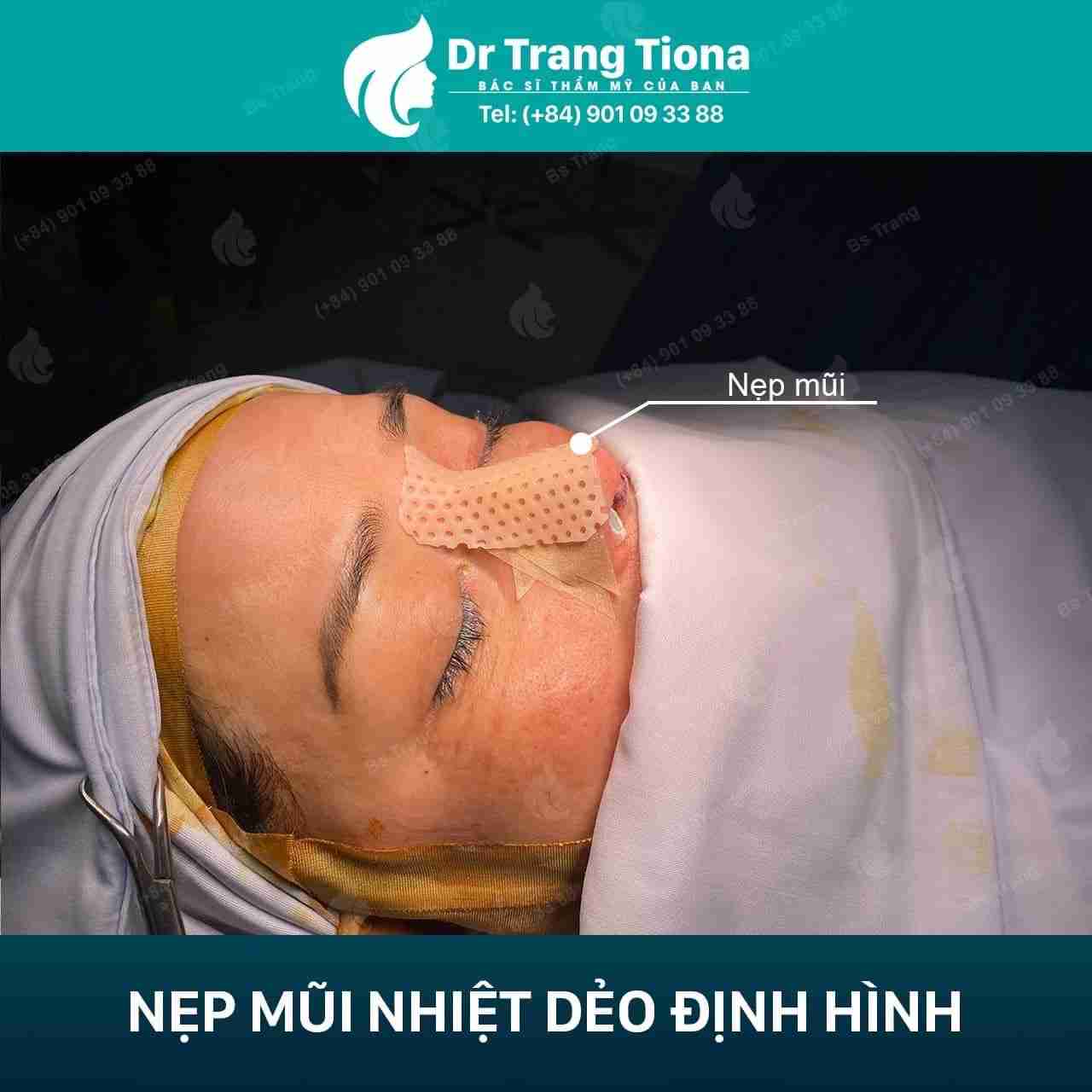 7 lưu ý quan trọng trước khi nâng mũi mà bạn cần phải biết
