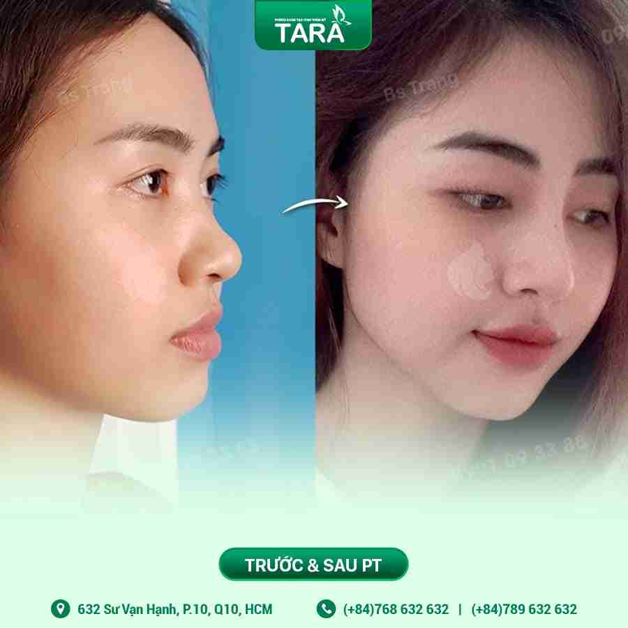 7 yếu tố nhận biết cơ sở nâng mũi uy tín