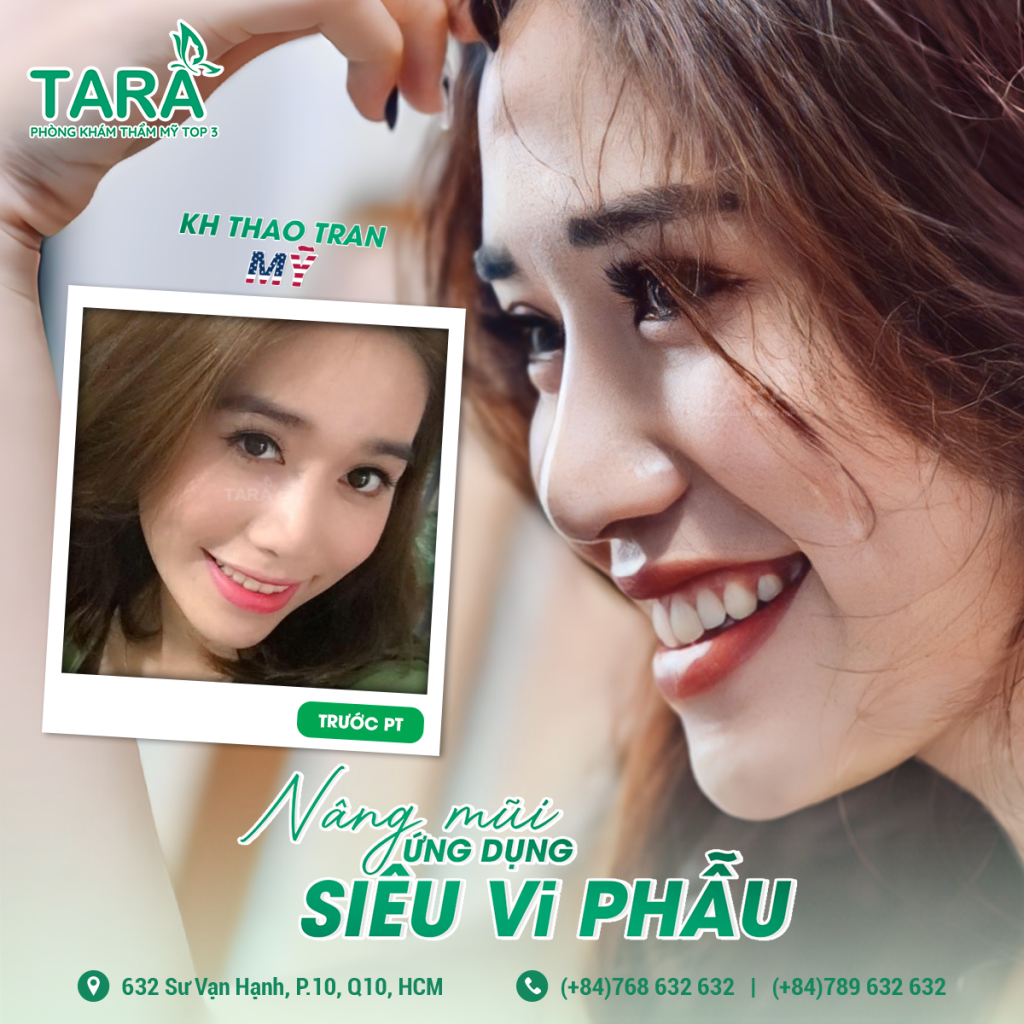 8 lý do nên chọn nâng mũi siêu vi phẫu tại TARA
