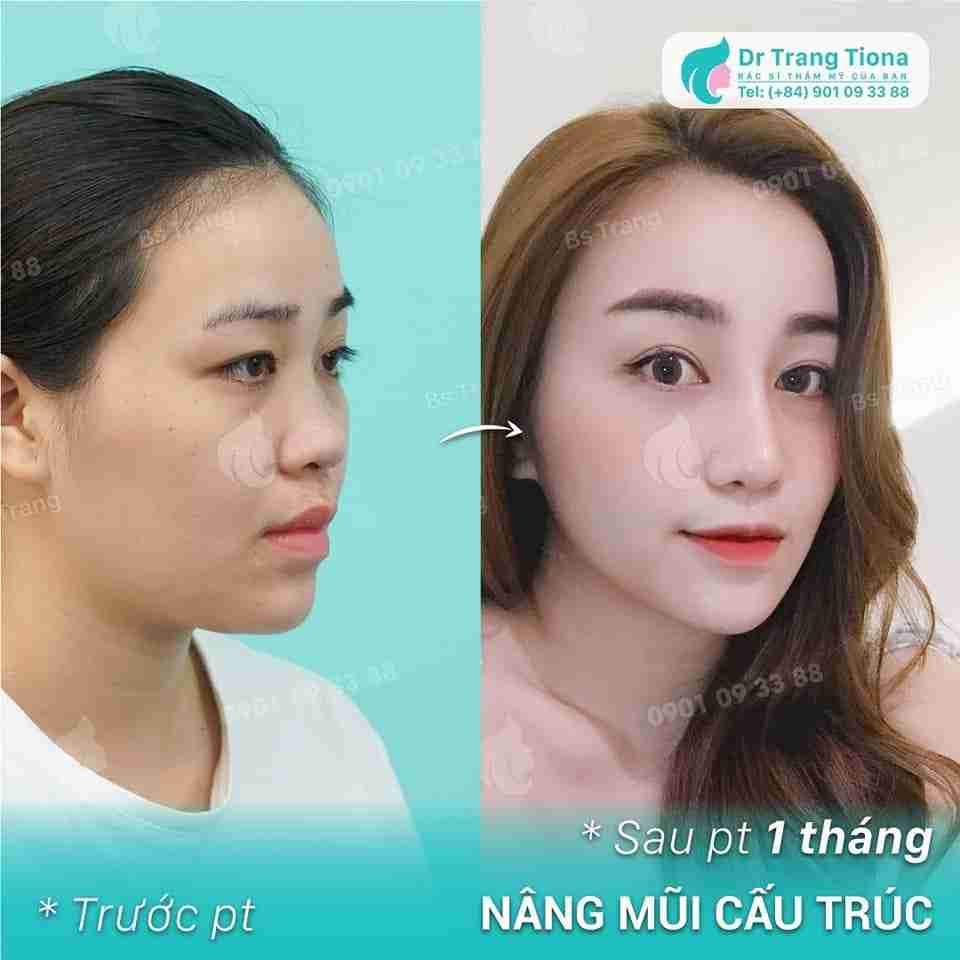 Ai nên nâng mũi cấu trúc? Tại sao?