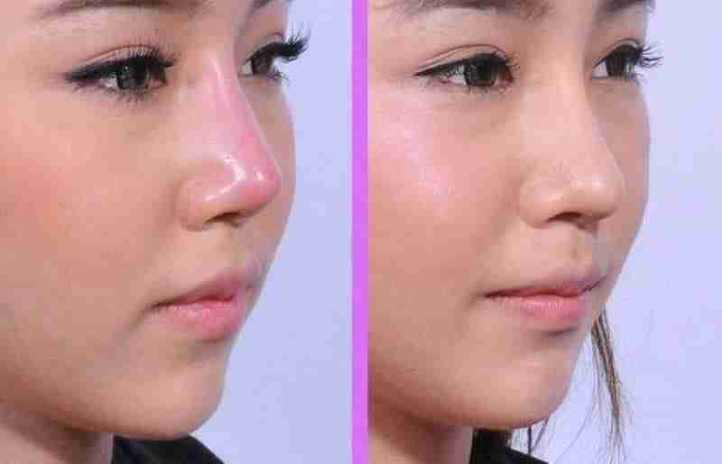 Bác sĩ giải đáp: Bị lộ sóng mũi sau nâng phải làm gì?