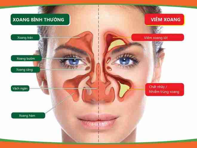 Bác sĩ giải đáp: bị viêm xoang có được nâng mũi không?