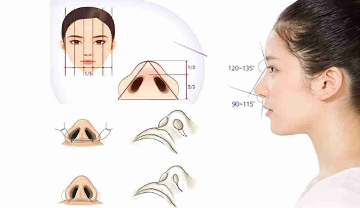 Bác sĩ giải đáp: Cắt cánh mũi có để lại sẹo xấu không?