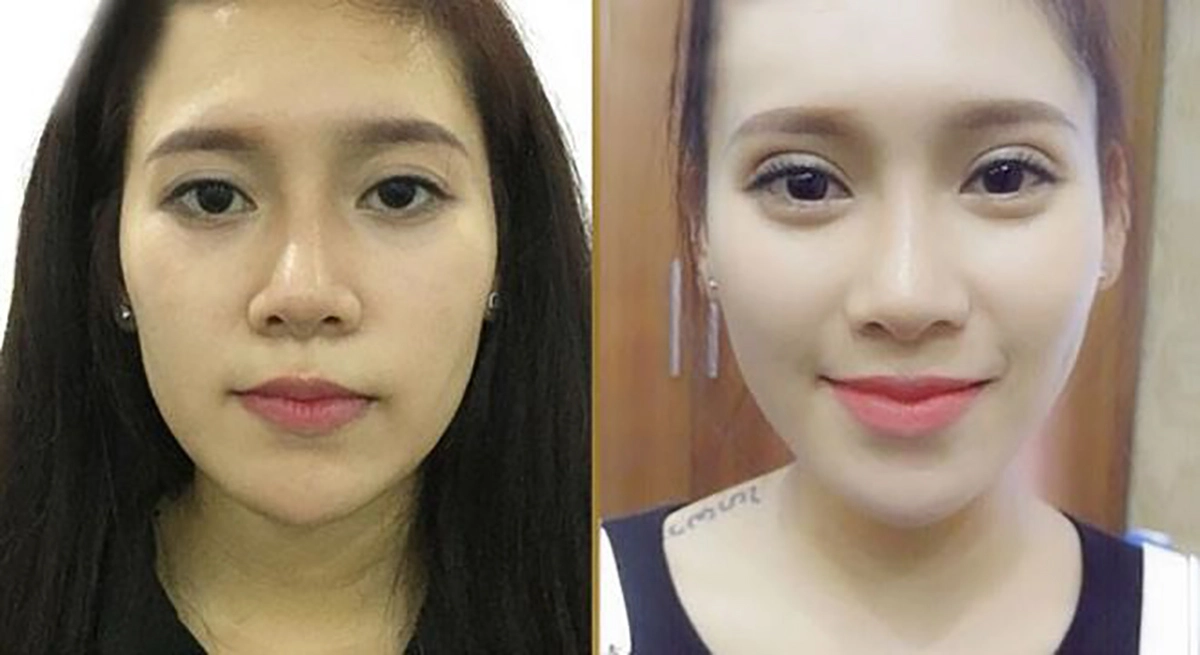 Bác sĩ giải đáp: Cắt mí mắt uống trà sữa có sao không?