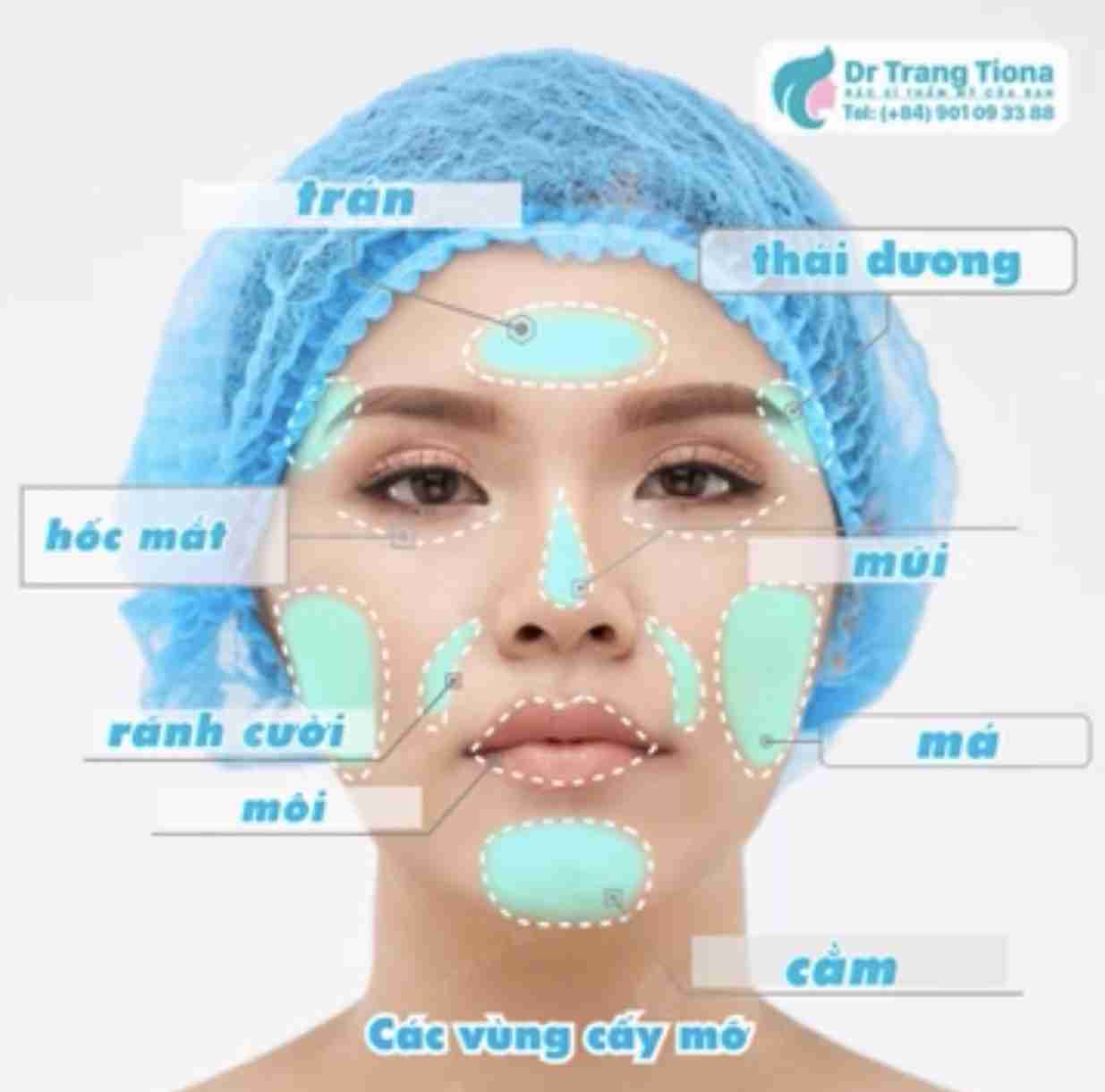 Bác sĩ giải đáp: Cấy mỡ mặt Babyface có bền không?