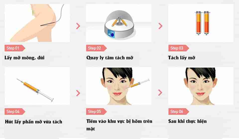 Bác sĩ giải đáp: Cấy mỡ mặt sưng lâu không?