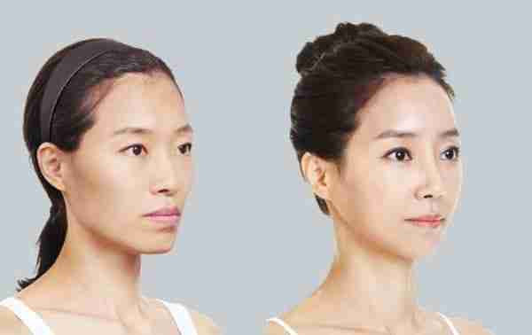 Bác sĩ giải đáp: Cấy mỡ mặt sưng lâu không?