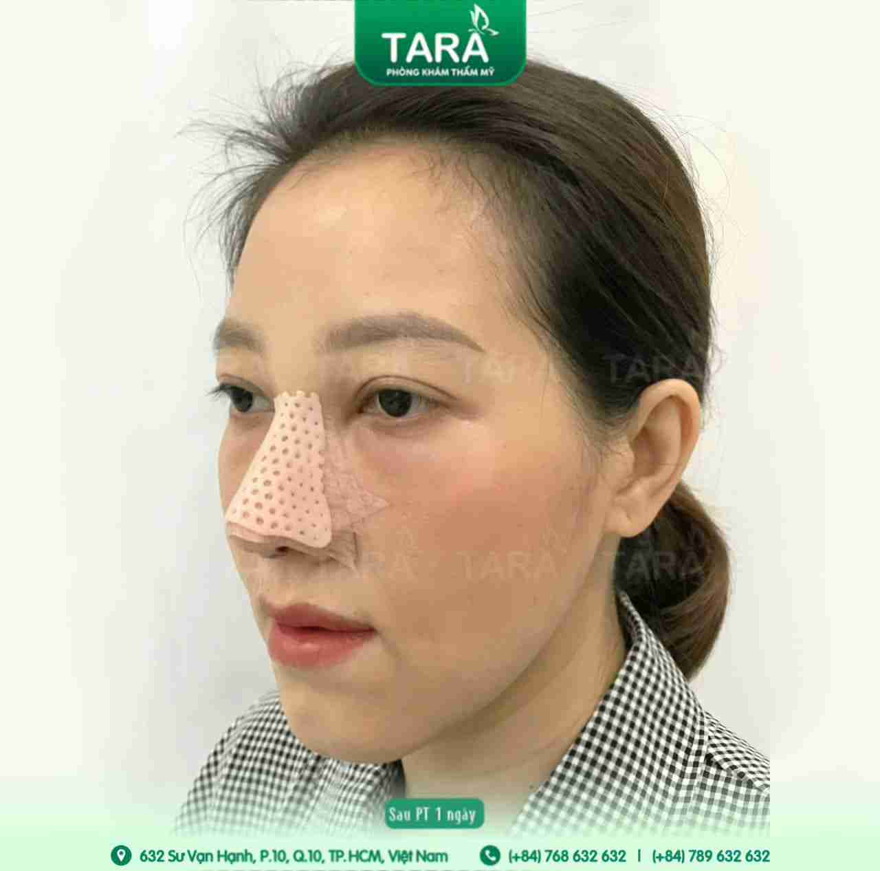 Bác sĩ giải đáp: Nâng mũi ăn bánh bông lan được không?
