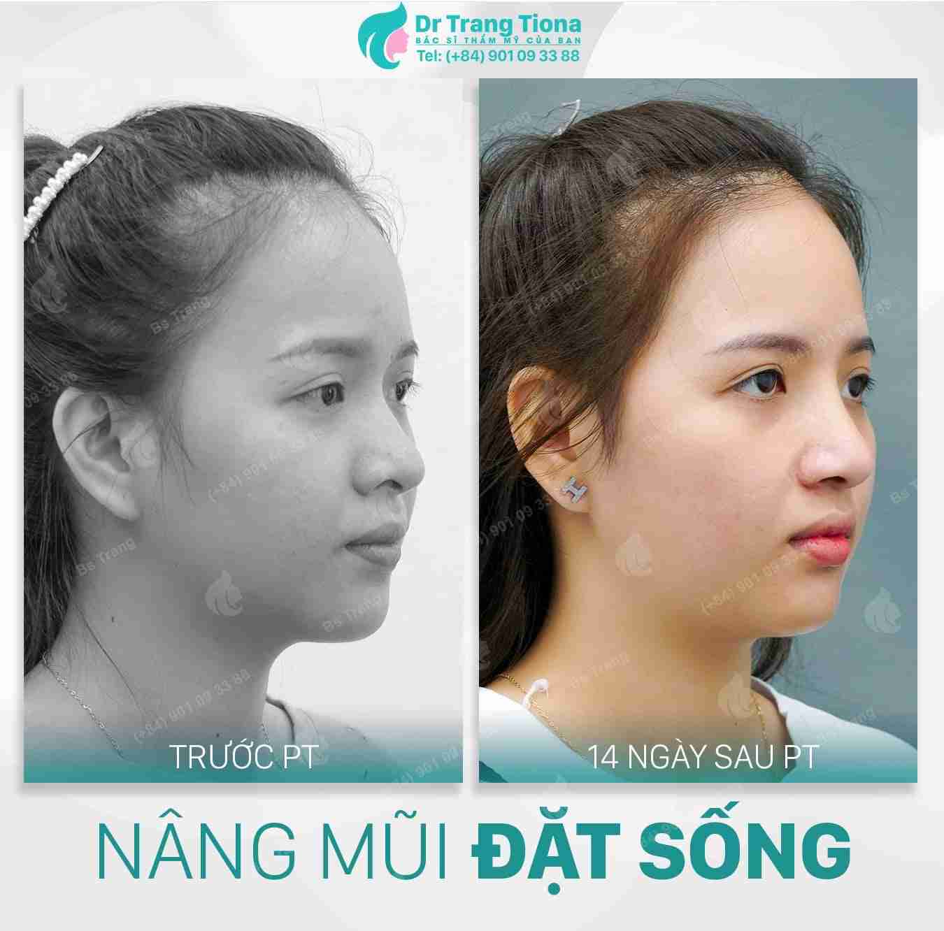 Bác sĩ giải đáp: Nâng mũi bị đỏ đầu mũi có sao không?